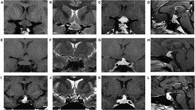 Clinical Characteristics of Pediatric Patients With Sellar and Suprasellar Lesions Who Initially Present With Central Diabetes Insipidus: A Retrospective Study of 55 Cases From a Large Pituitary Center in China